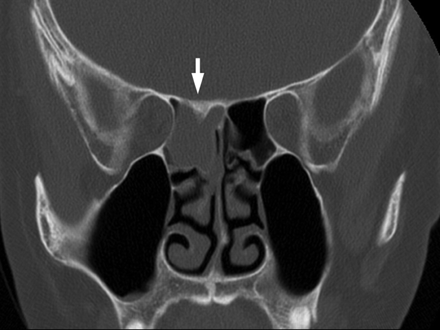 Sinus papilloma
