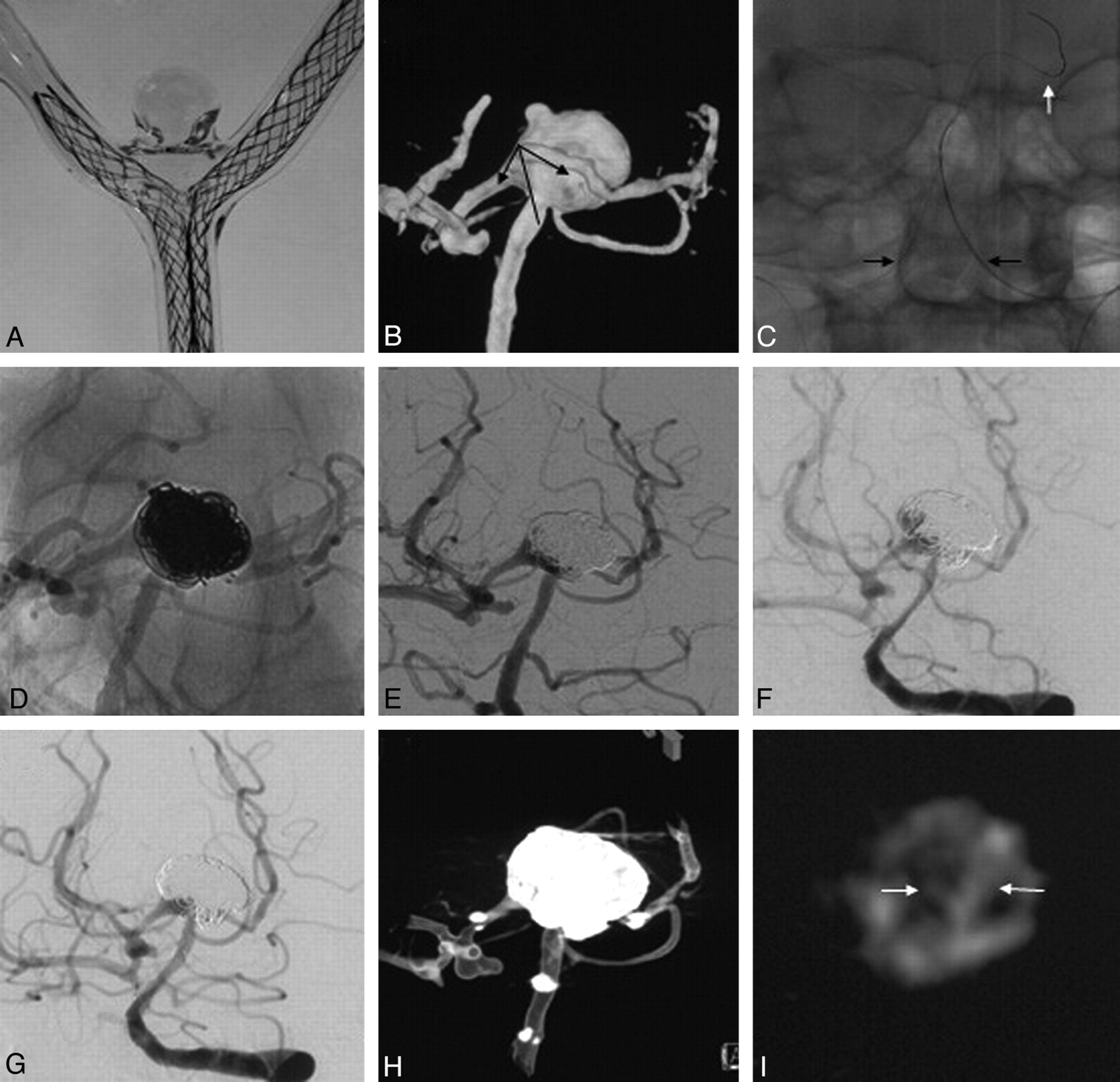 Fig 4., Y-Configuration Stent Placement (Crossing and Kissing) for  Endovascular Treatment of Wide-Neck Cerebral Aneurysms Located at 4  Different Bifurcation Sites