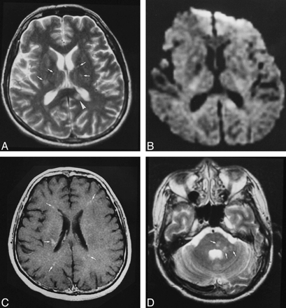 Nipah Viral Encephalitis or Japanese Encephalitis? MR Findings in a New ...