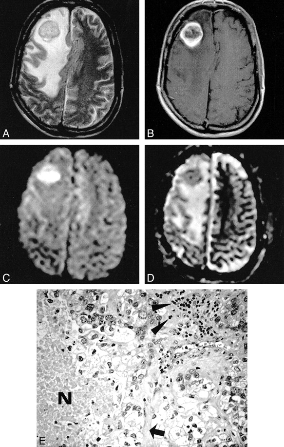 Meningioma with ring enhancement on MRI: a rare case report | BMC Medical  Imaging | Full Text
