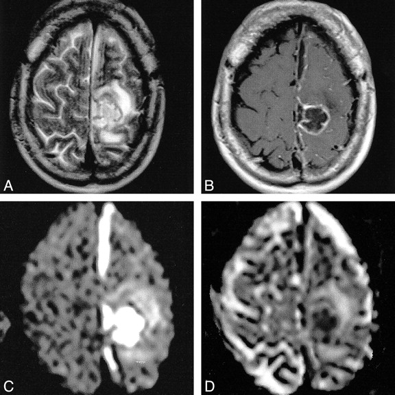 Multiple ring-enhancing lesions: diagnostic dilemma between  neurocysticercosis and tuberculoma | BMJ Case Reports