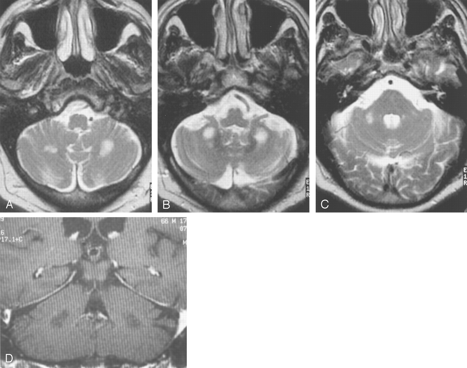 Fragile X Premutation Carriers: Characteristic MR Imaging