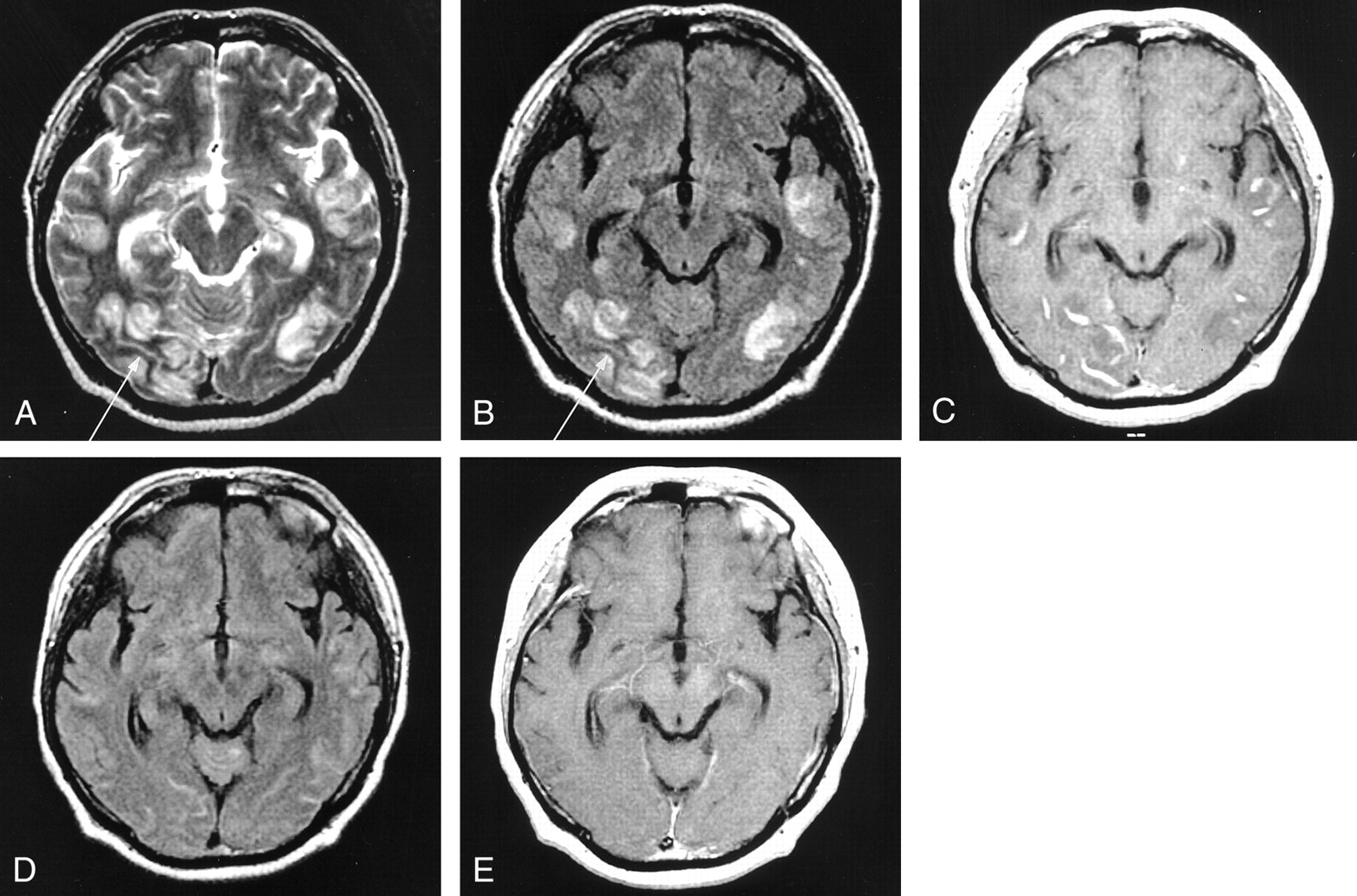 Subcortical Low Intensity on MR Images of Meningitis, Viral ...