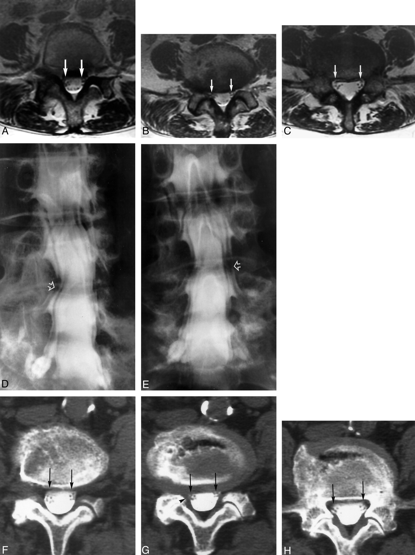 Thecal Sac Indentation