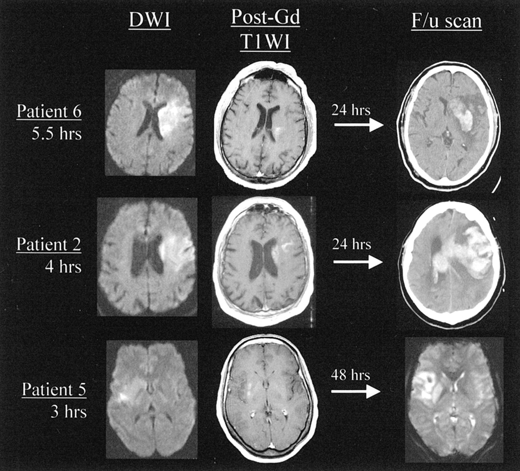 MR Imaging Enhancement Patterns as Predictors of Hemorrhagic ...