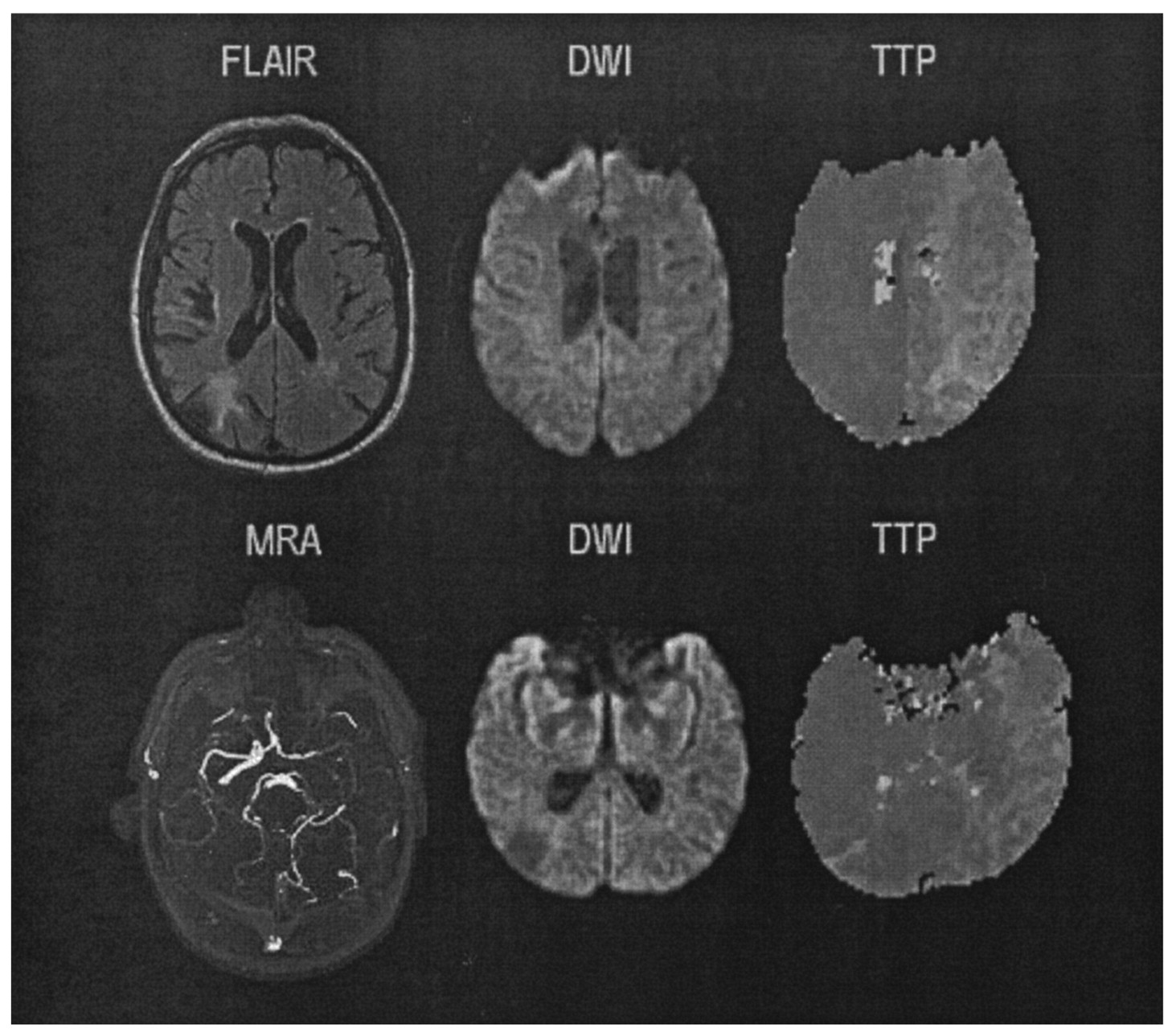 Assessment of Transient Ischemic Attack with Diffusion- and Perfusion ...