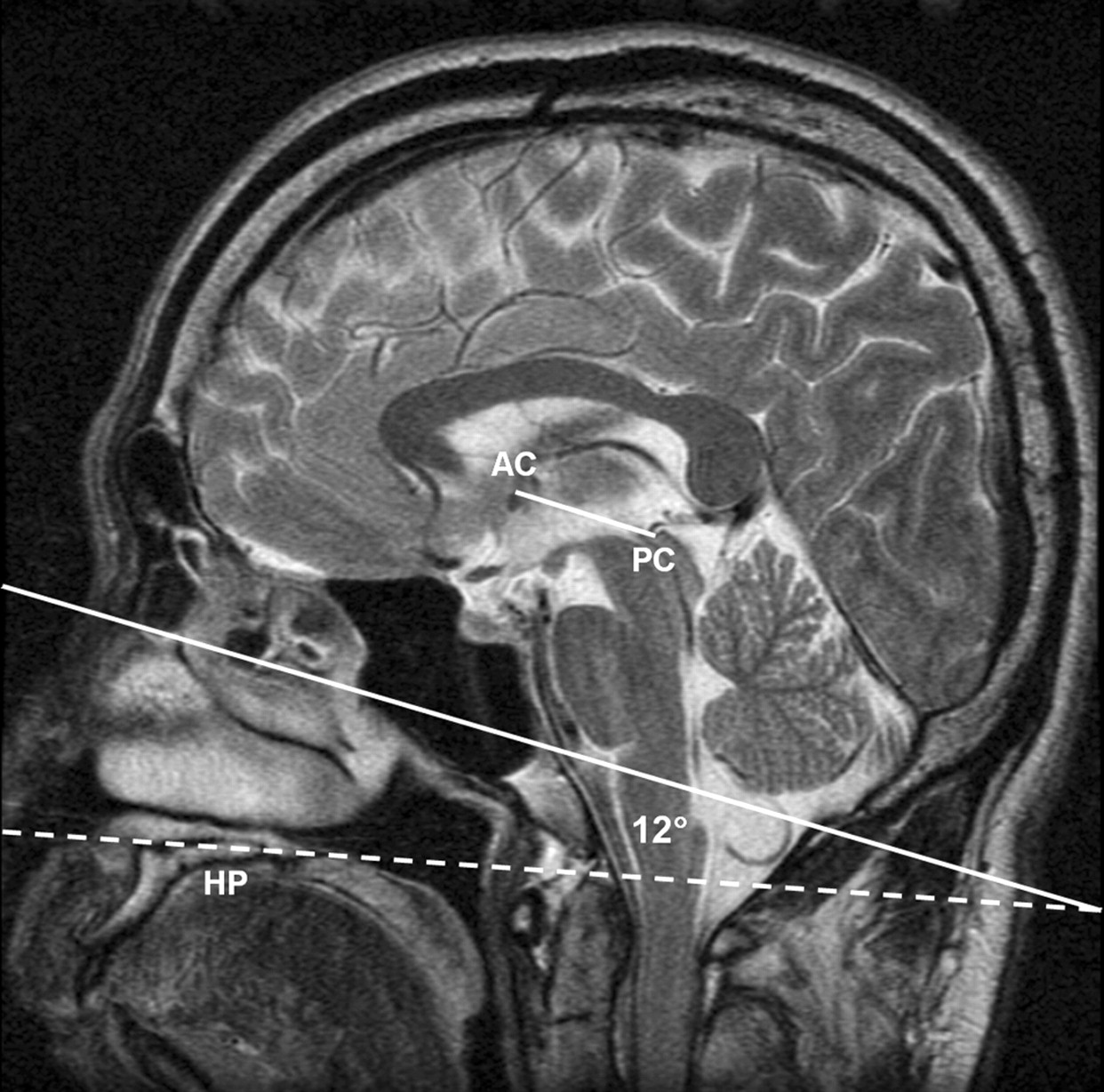CT Brain Prescriptions in Talairach Space: A New Clinical Standard