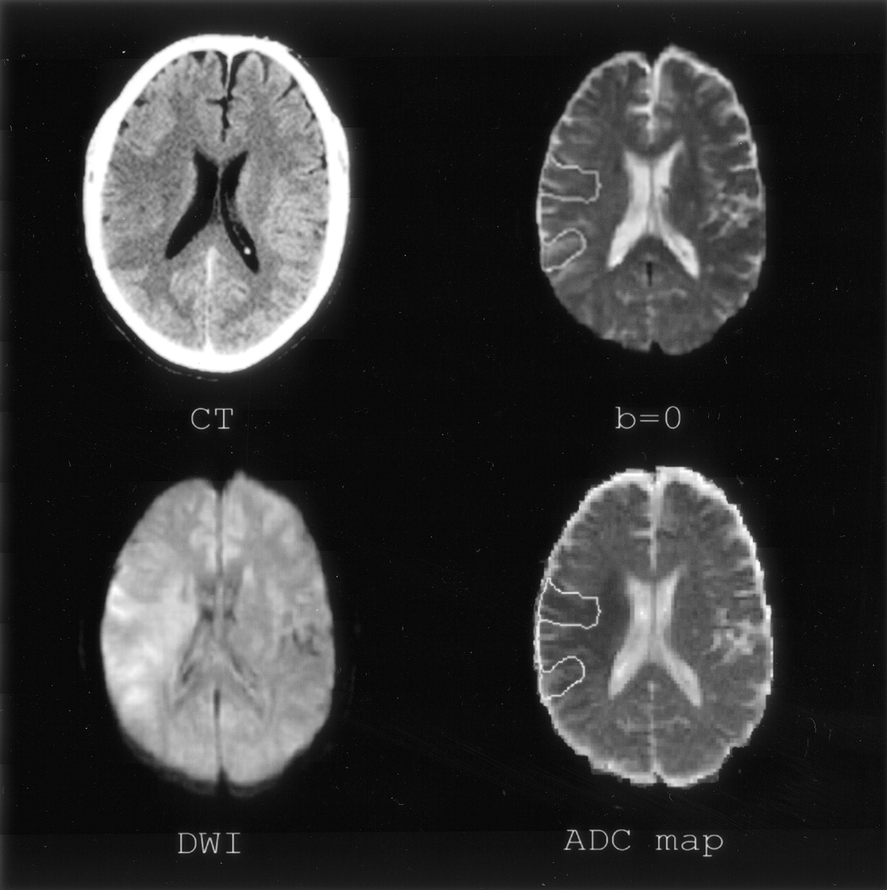 Association of Early CT Abnormalities, Infarct Size, and Apparent ...