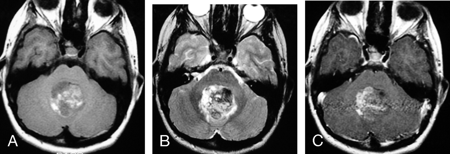 Primary Intracranial Atypical Teratoid/Rhabdoid Tumors of Infancy and ...