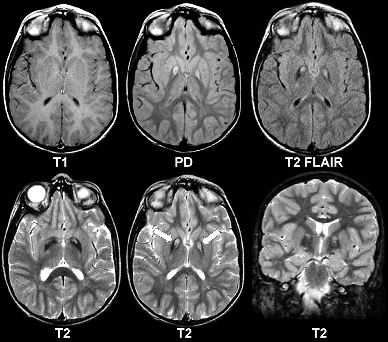Brain MRI in Neurodegeneration with Brain Iron Accumulation with and ...