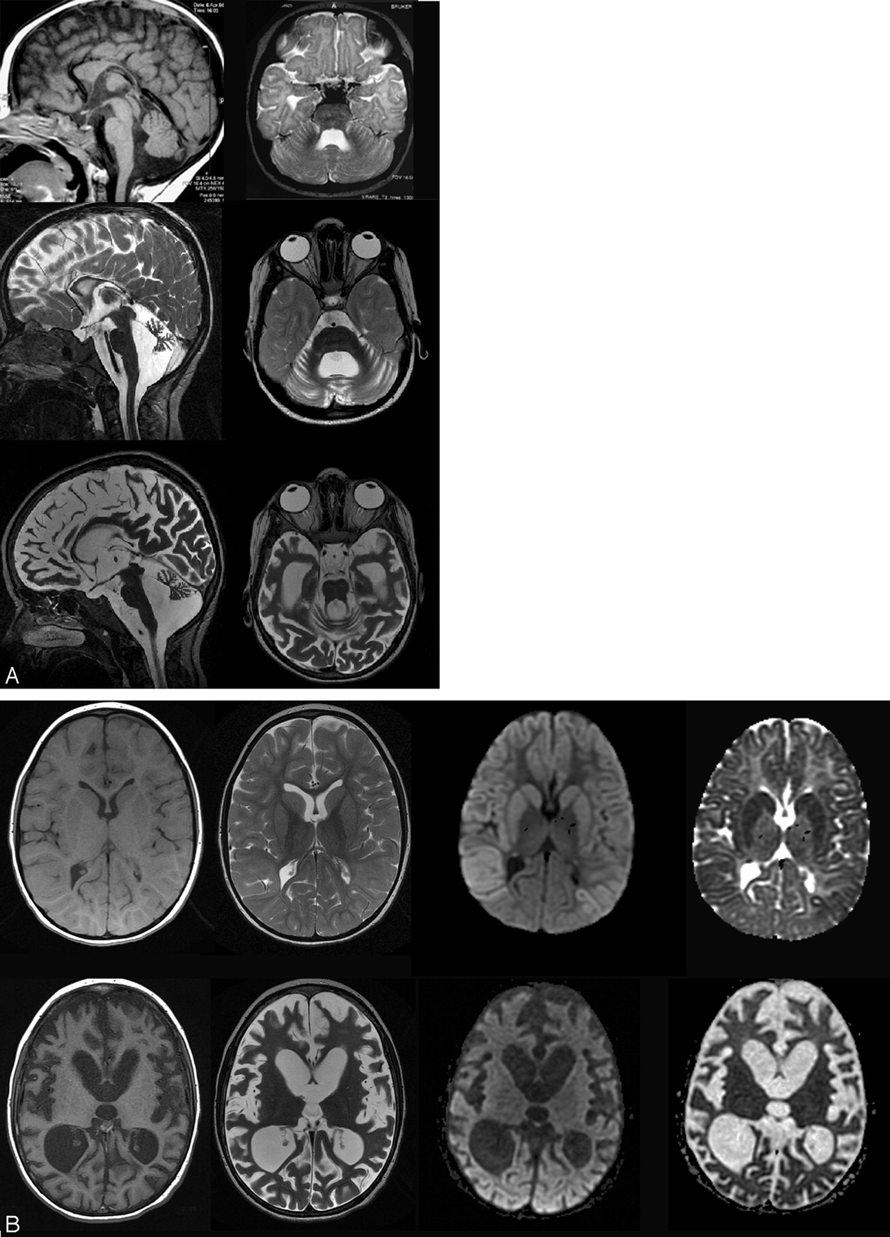 Serial MR Imaging, Diffusion Tensor Imaging, and MR Spectroscopic Findings  in a Child with Progressive Encephalopathy, Edema, Hypsarrhythmia, and  Optic Atrophy (PEHO) Syndrome | American Journal of Neuroradiology