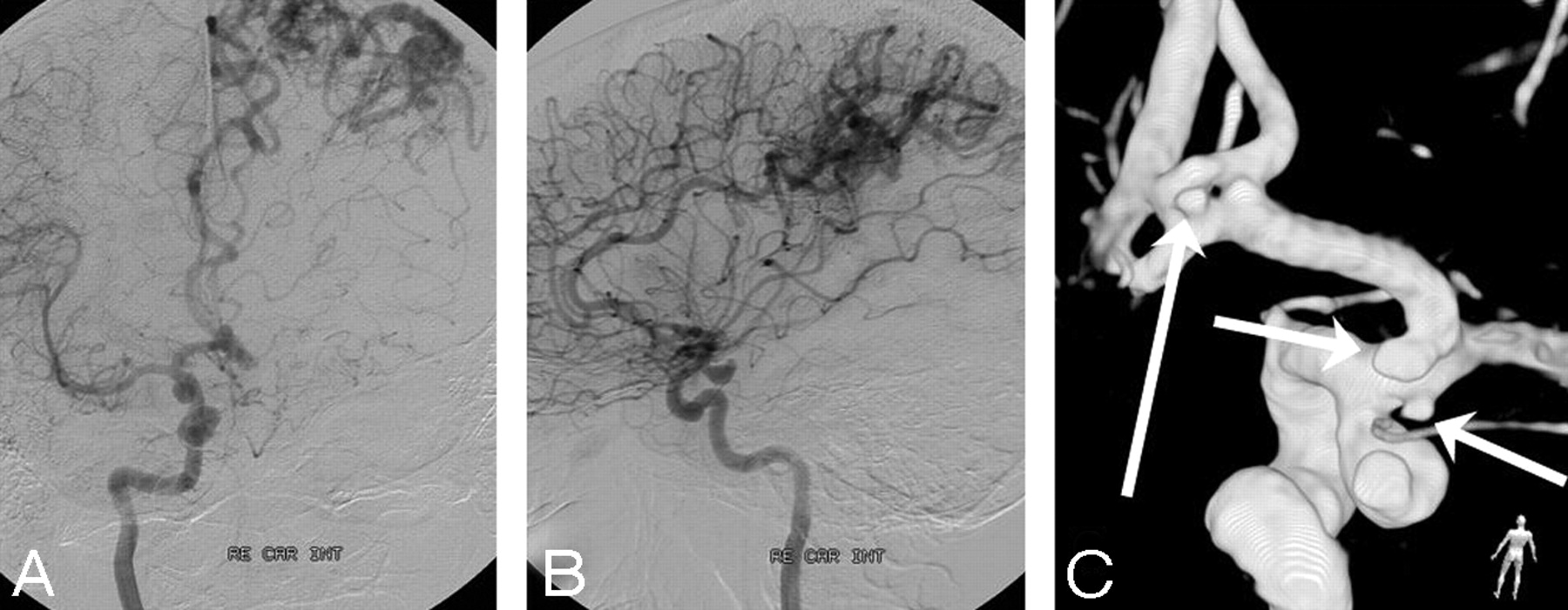 3D Rotational Angiography: The New Gold Standard in the Detection of  Additional Intracranial Aneurysms | American Journal of Neuroradiology