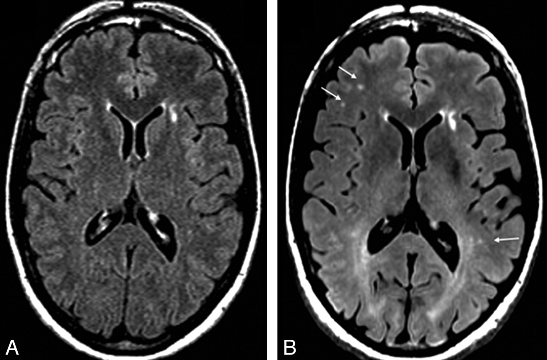 Normal on Brain Fluid-Attenuated Inversion Recovery MR Images at 3T | American Journal of Neuroradiology