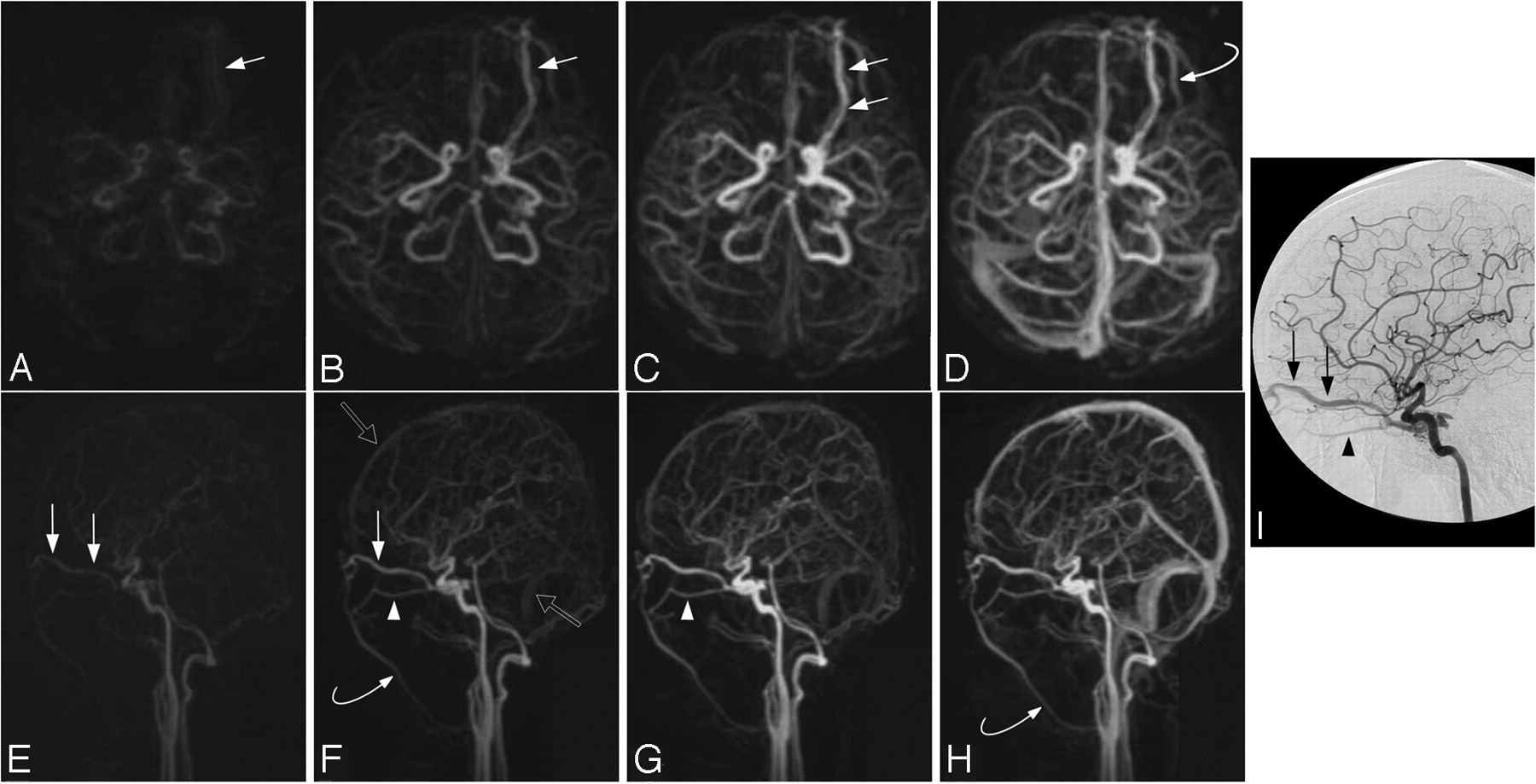 Cranial Dural Arteriovenous Fistula: Diagnosis and Classification Cranial Dural Arteriovenous Fistula: Diagnosis and Classification