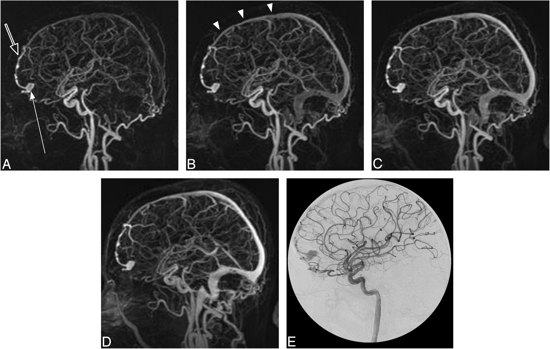 Cranial Dural Arteriovenous Fistula: Diagnosis and Classification Cranial Dural Arteriovenous Fistula: Diagnosis and Classification