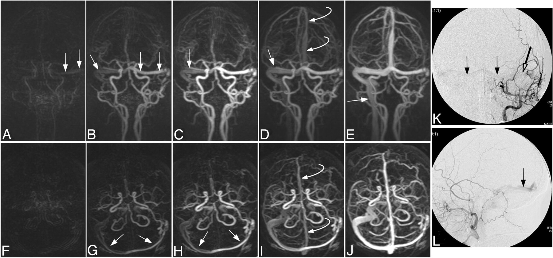 Cranial Dural Arteriovenous Fistula: Diagnosis and Classification 