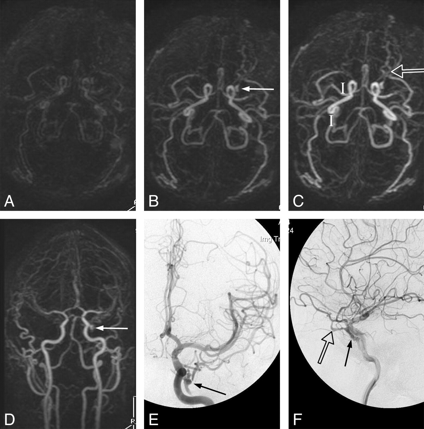 Cranial Dural Arteriovenous Fistula: Diagnosis and Classification Cranial Dural Arteriovenous Fistula: Diagnosis and Classification