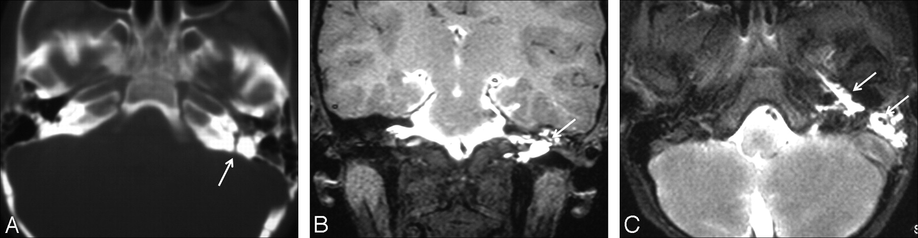 Intrathecal Gadolinium-Enhanced MR Cisternography in the Evaluation of ...