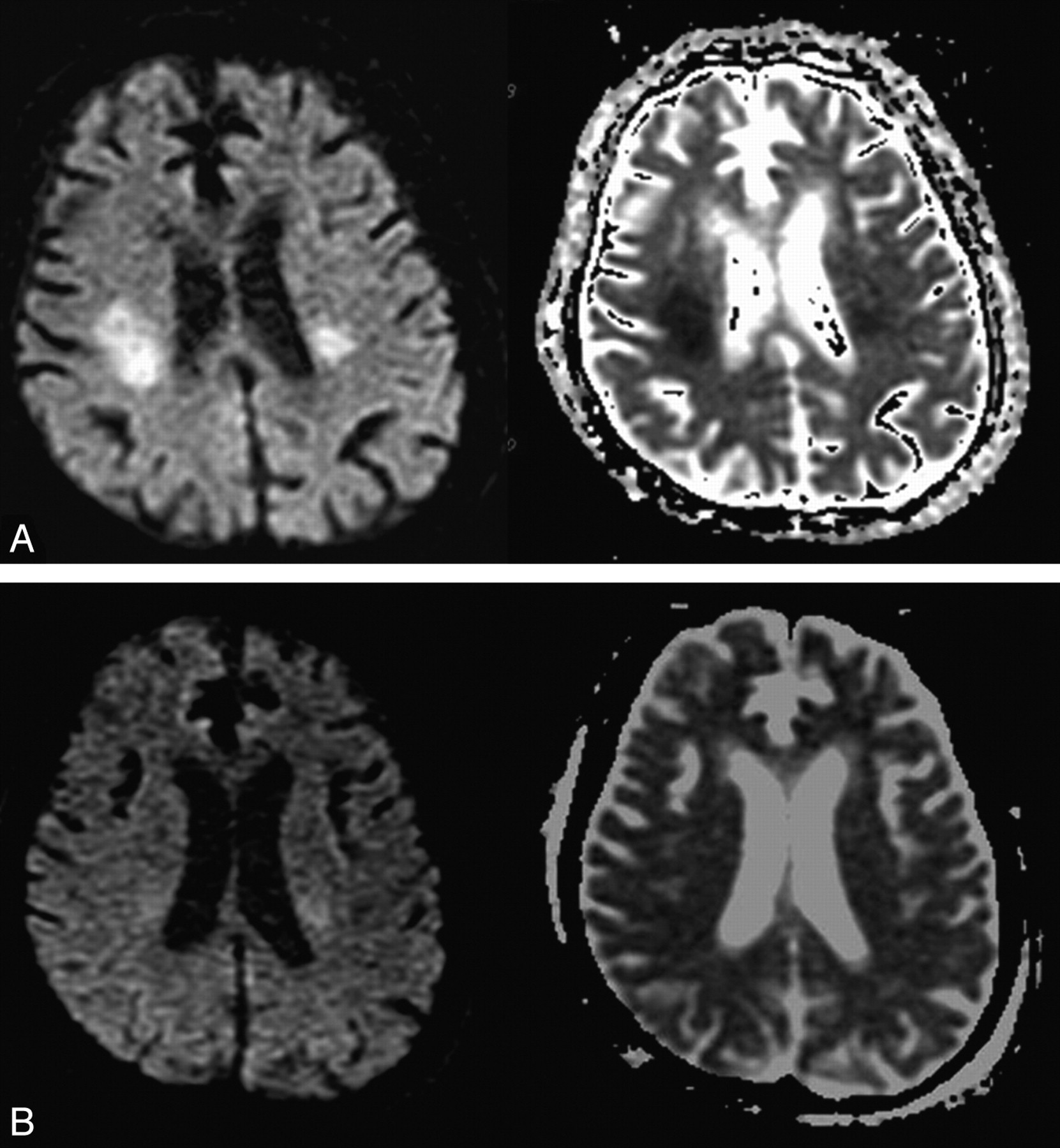 Diffusion MR Imaging of Hypoglycemic Encephalopathy | American Journal ...