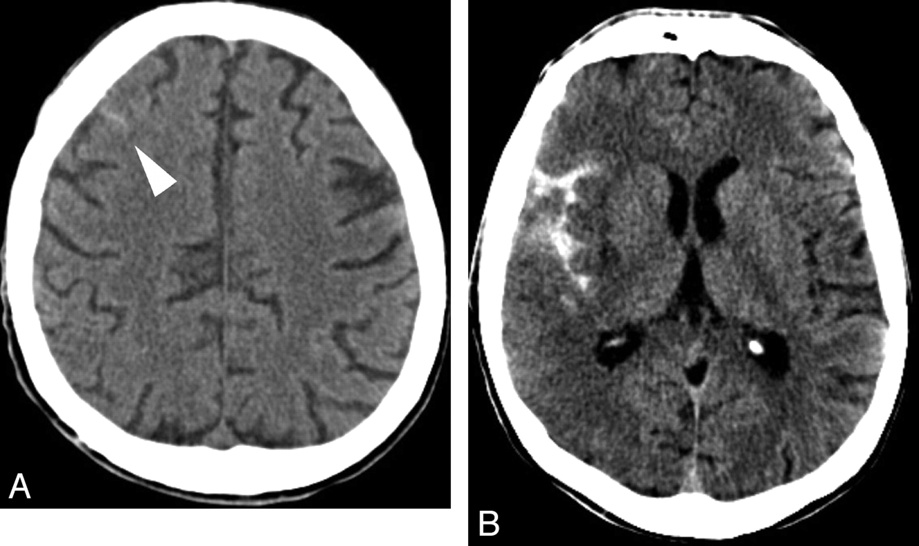 CT brain image gallery - SAH