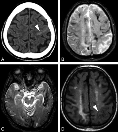 Isolated Acute Nontraumatic Cortical Subarachnoid Hemorrhage | American ...