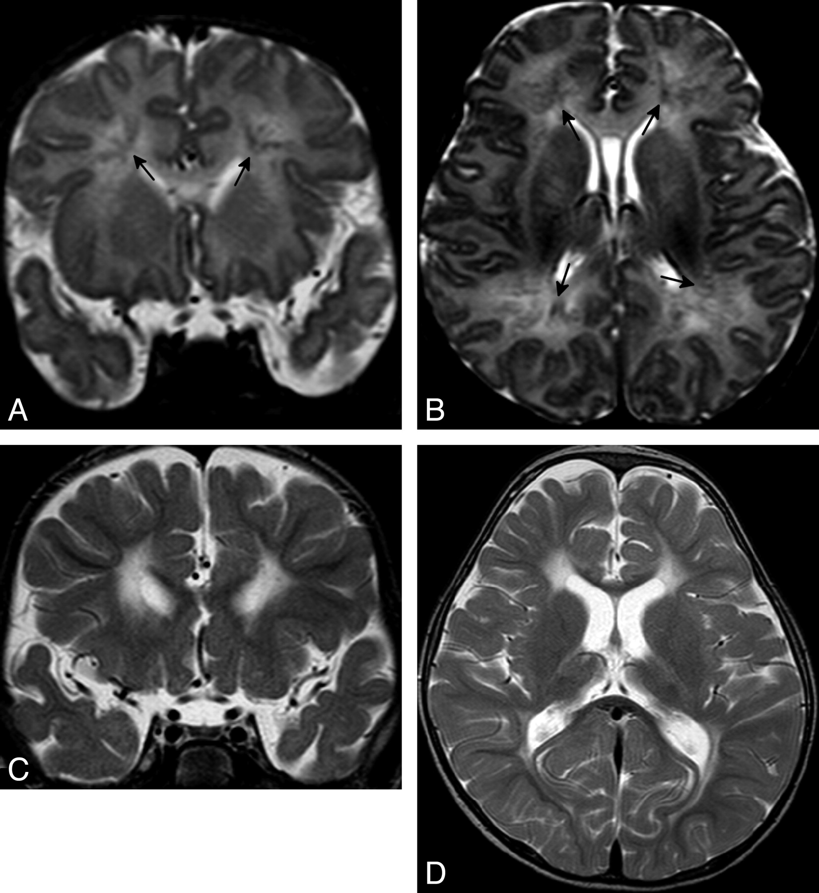 Deep Medullary Vein Involvement in Neonates with Brain Damage: An MR ...
