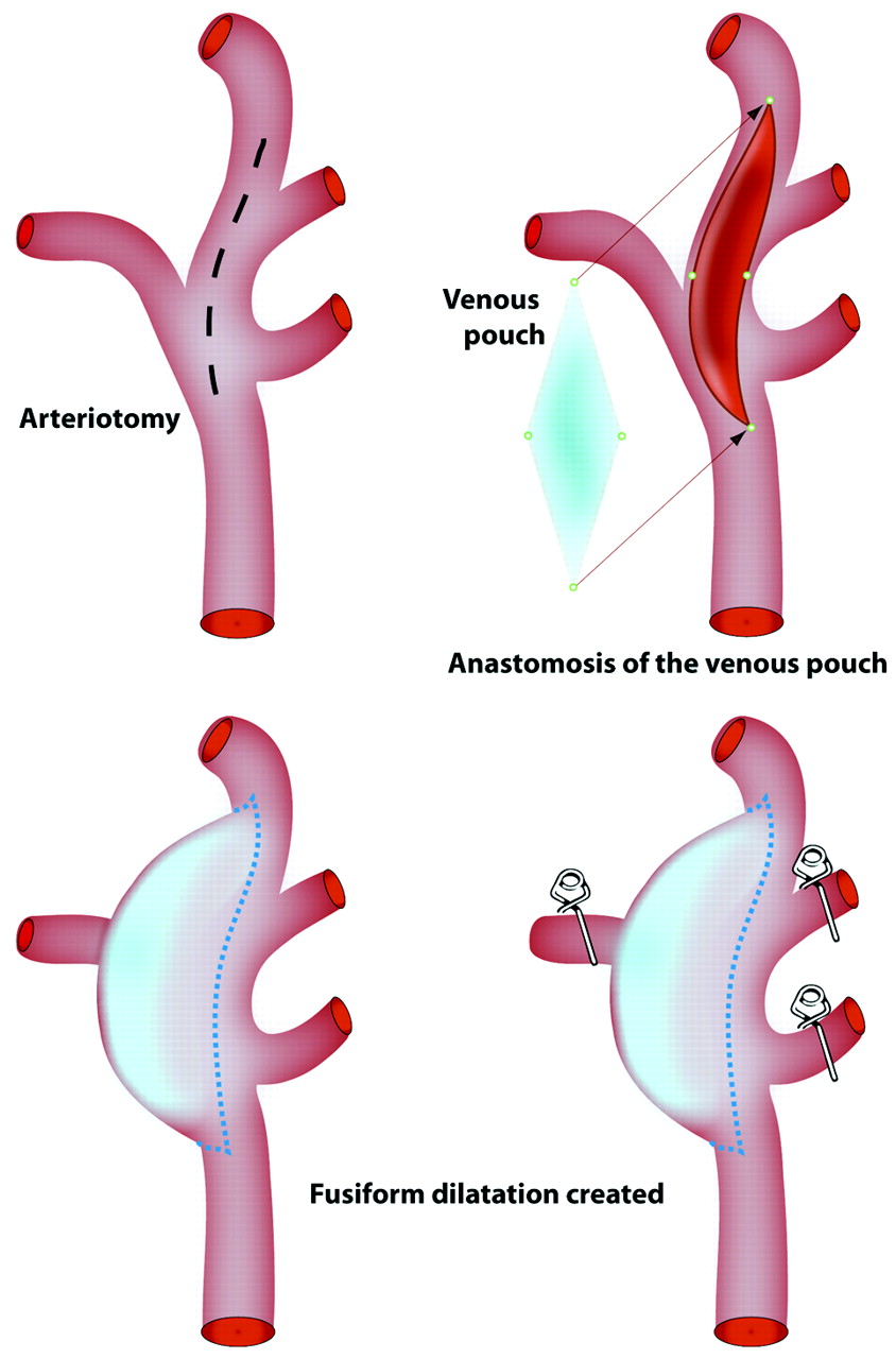 Testing Flow Diverters in Giant Fusiform Aneurysms: A New Experimental ...