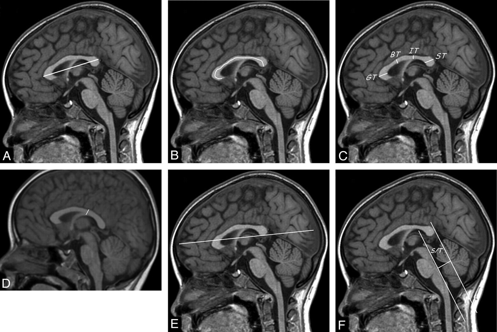 Fig 1. | Biometry of the Corpus Callosum in Children: MR