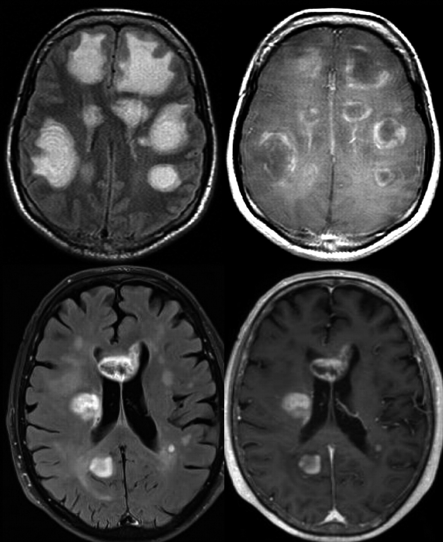 Bracco Diagnostics' MultiHance Contrast Agent Earns Expanded Labeling for  Pediatric MRI