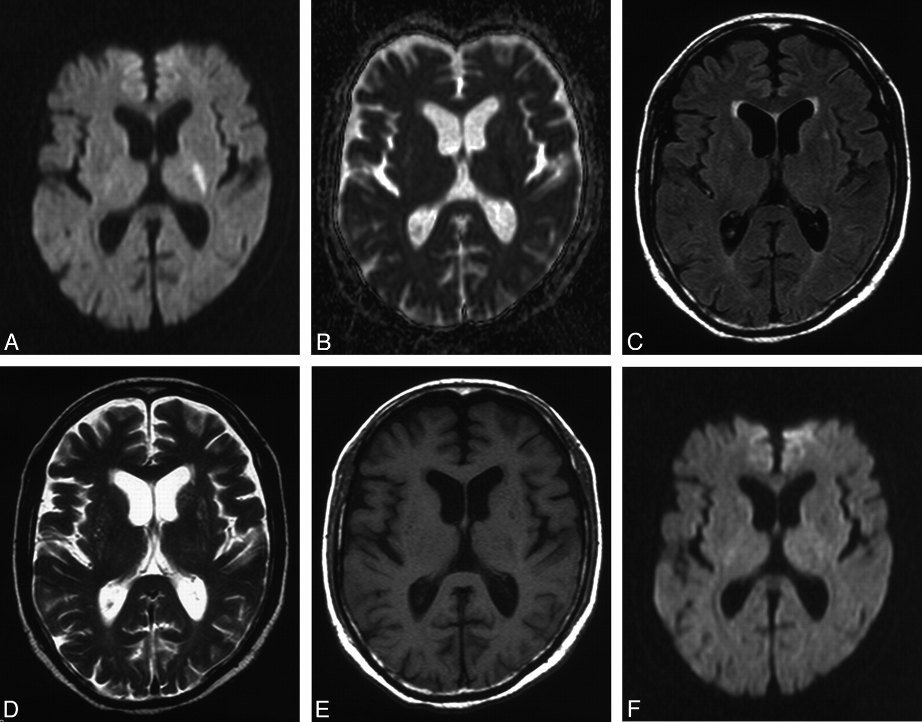 Early Diffusion MR Imaging Findings and Short-Term Outcome in Comatose ...