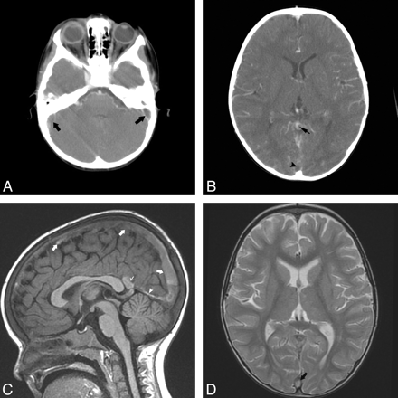 Does Intracranial Venous Thrombosis Cause Subdural Hemorrhage in the ...