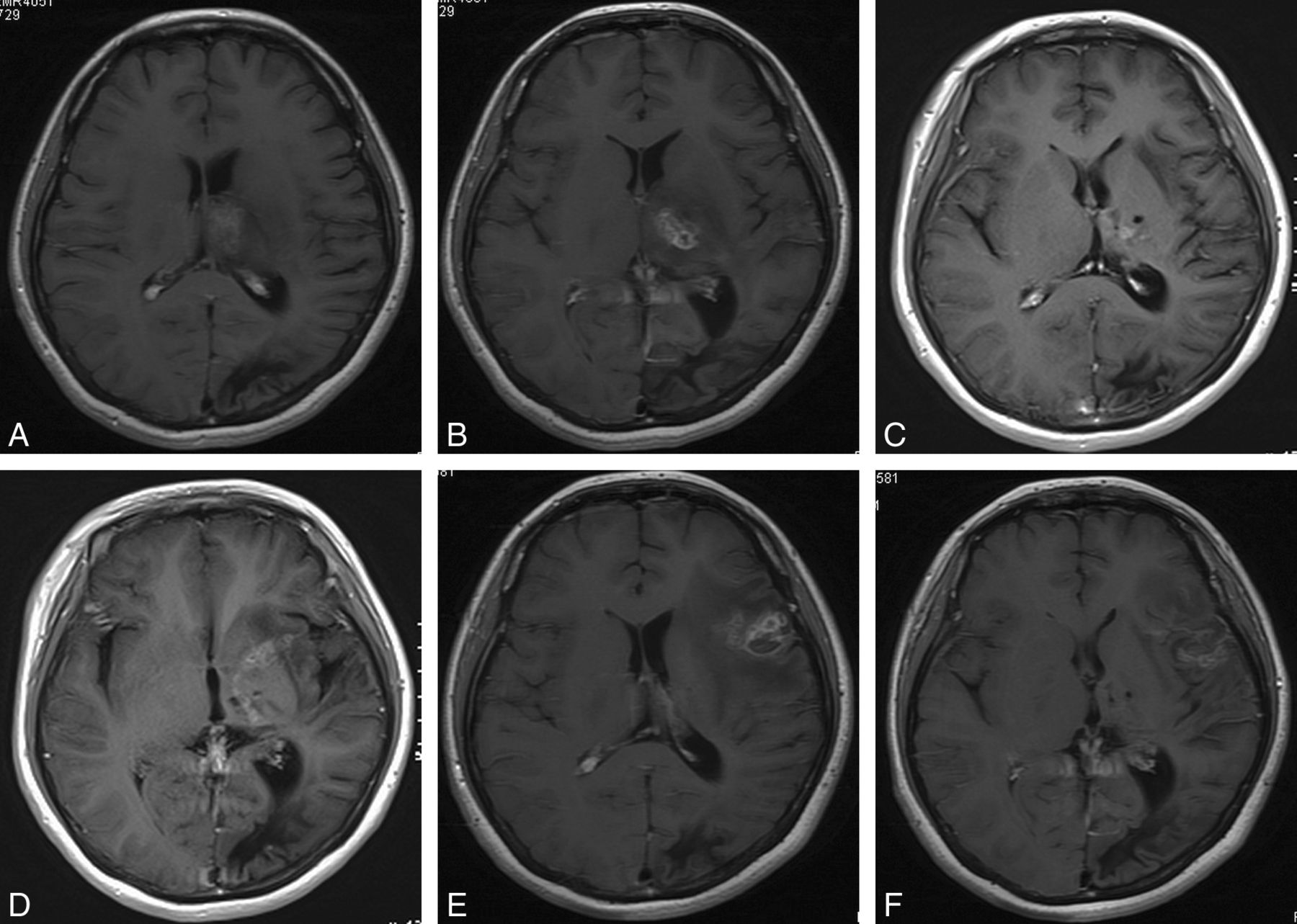 Ring enhancing brain lesions: A Radiology Differential Diagnostic Challenge