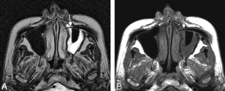 Fig 14.