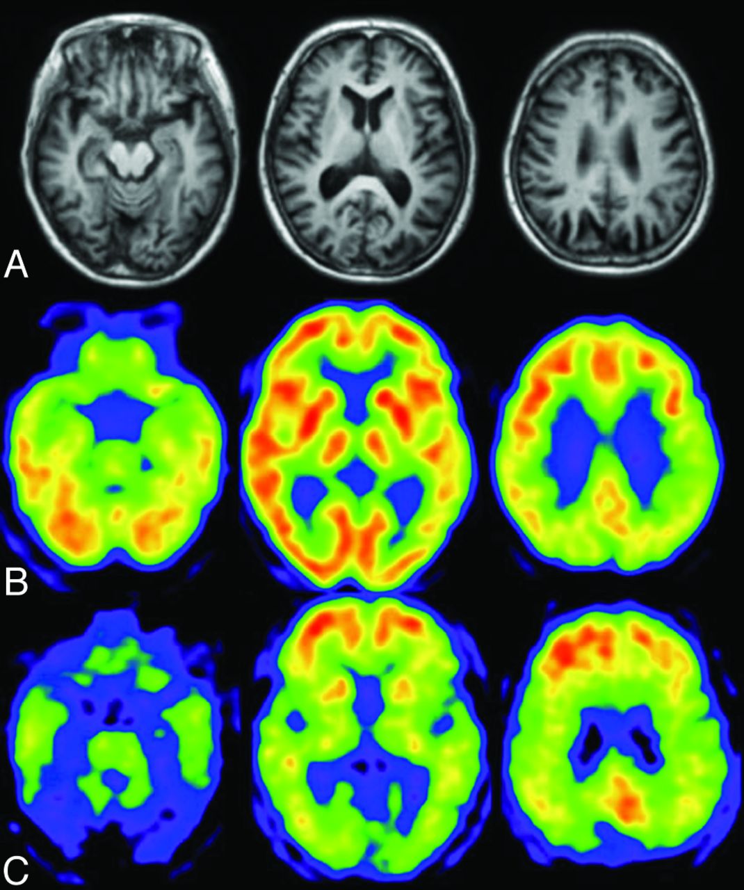 Approaches for Diagnosis of Dementia American Journal of Neuroradiology