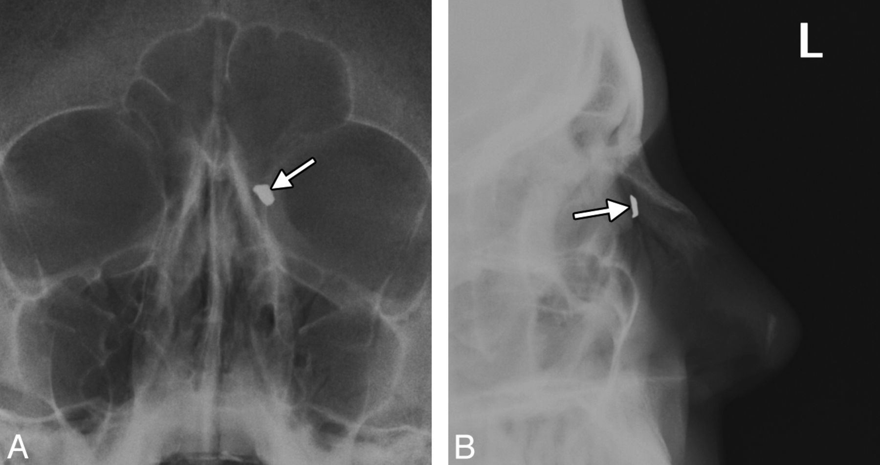 Nasal Bone Xray