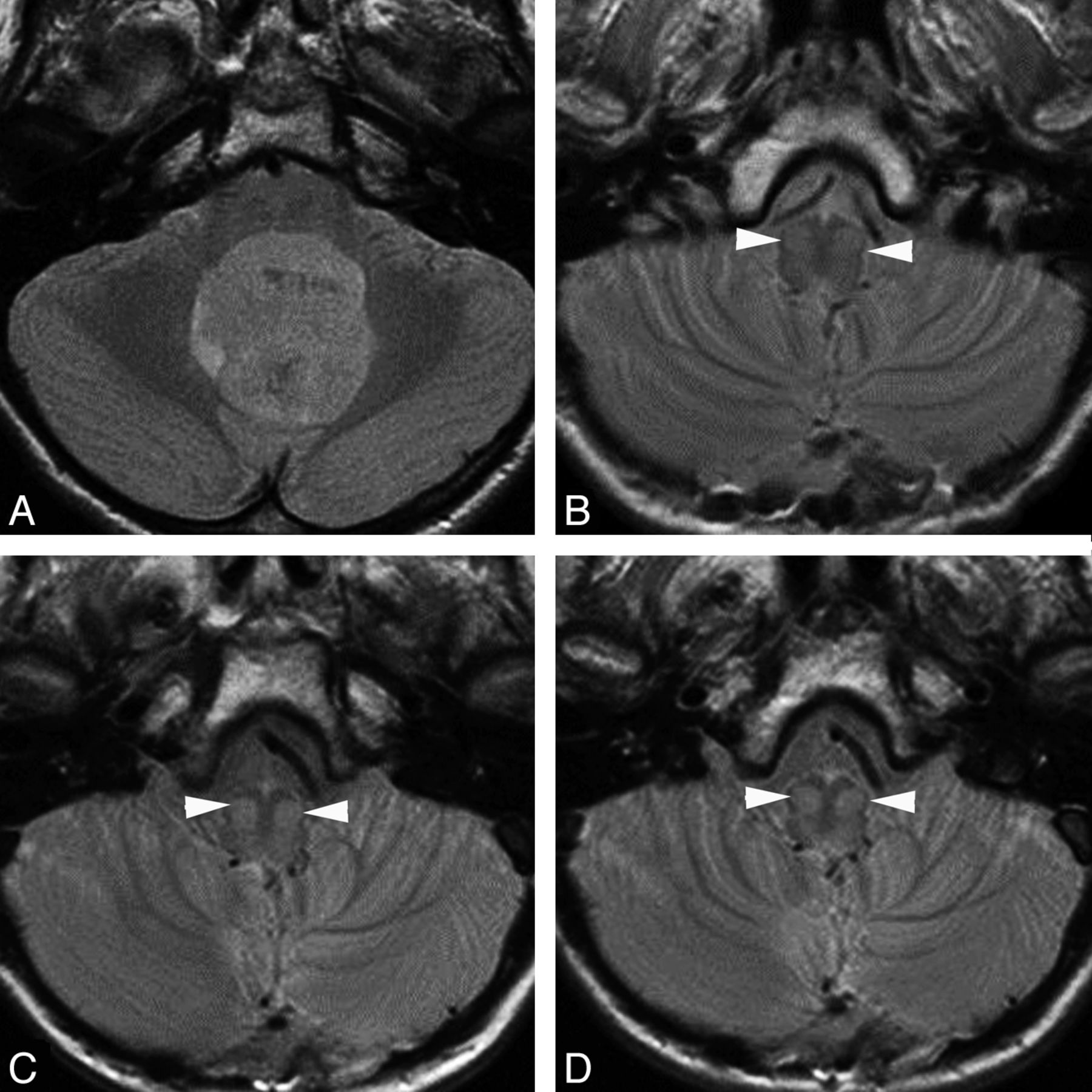 MR Imaging Evaluation of Inferior Olivary Nuclei: Comparison of  Postoperative Subjects with and without Posterior Fossa Syndrome | American  Journal of Neuroradiology