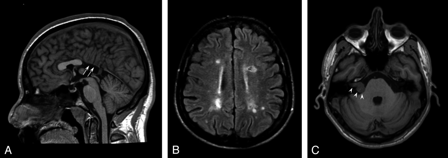 Mr da. Corpus callosum posterior ischemia MRI. Конвенциональный мозг.