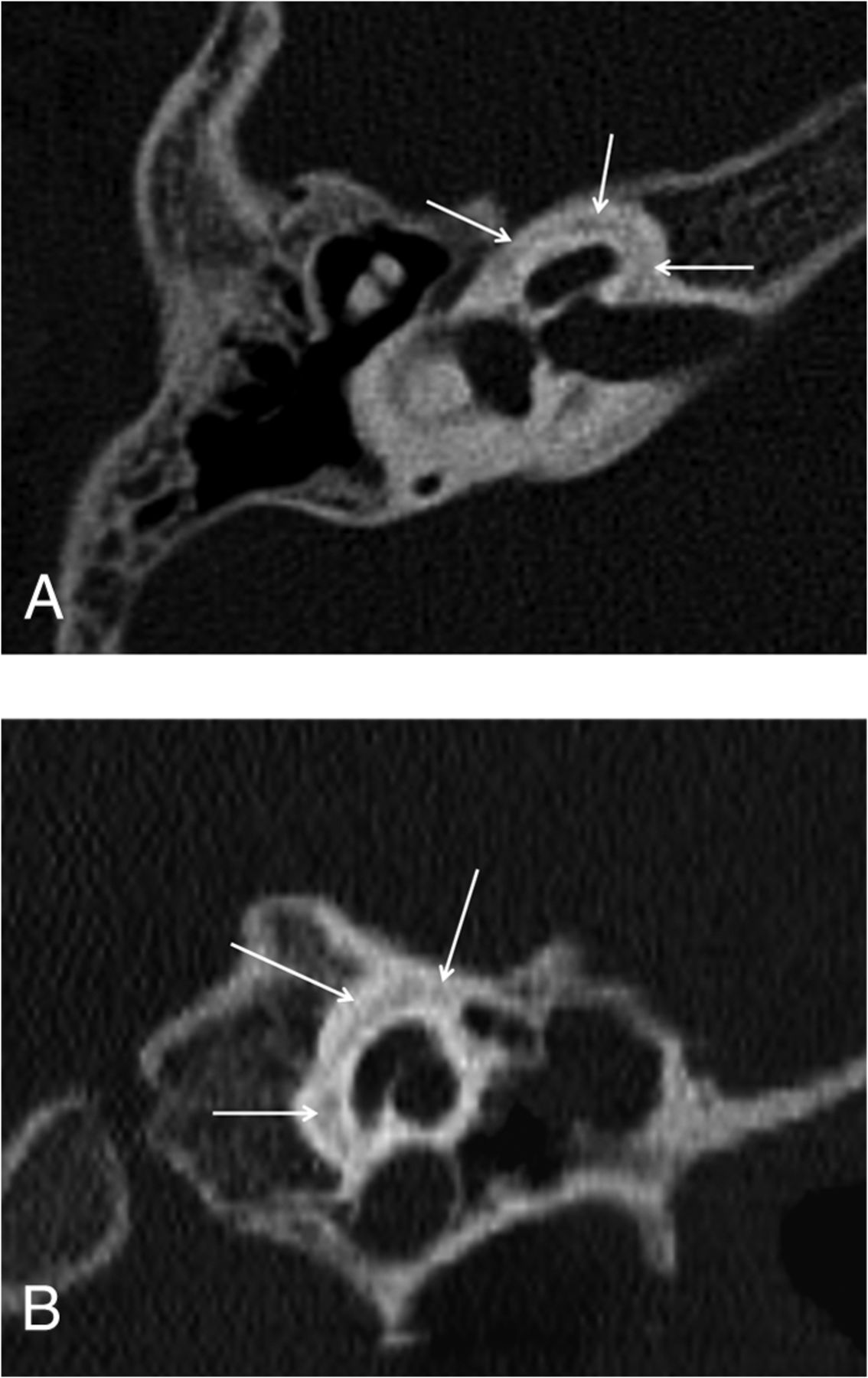 Incomplete Endochondral Ossification of the Otic Capsule, A Variation ...