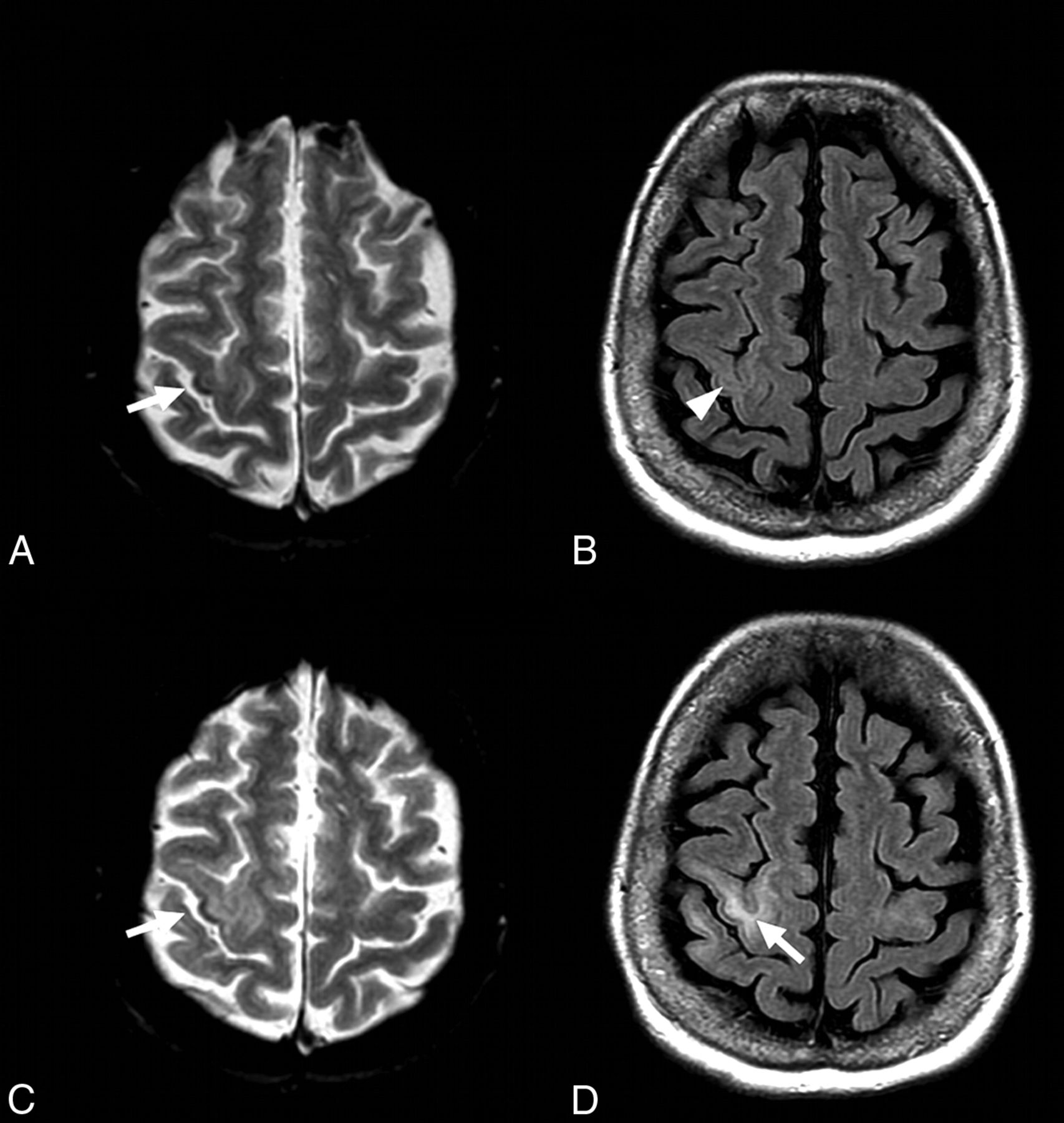 Brain Magnetic Susceptibility Changes in Patients with Natalizumab ...