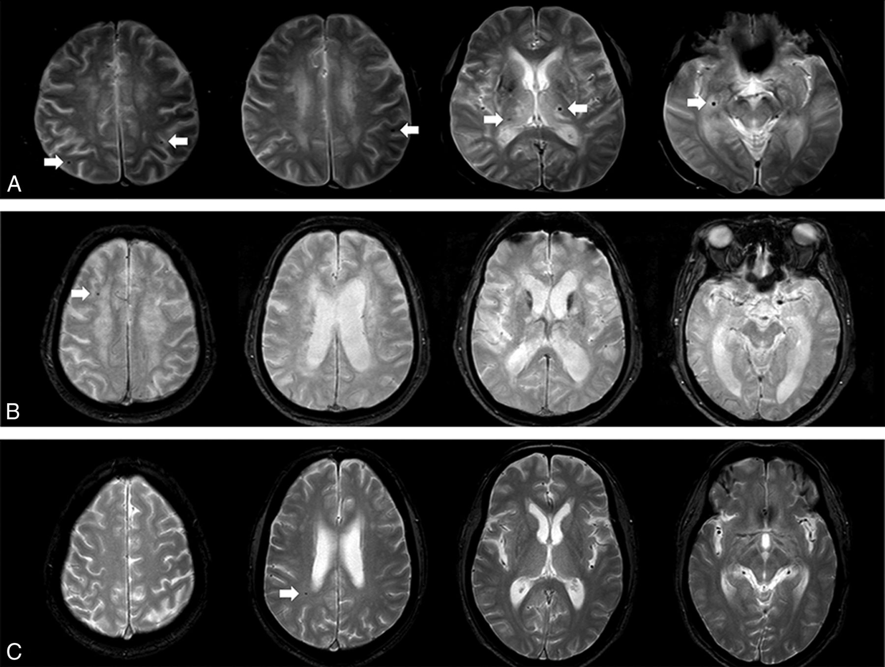 Cerebral Microbleeds in Patients with Dementia with Lewy Bodies and  Parkinson Disease Dementia | American Journal of Neuroradiology