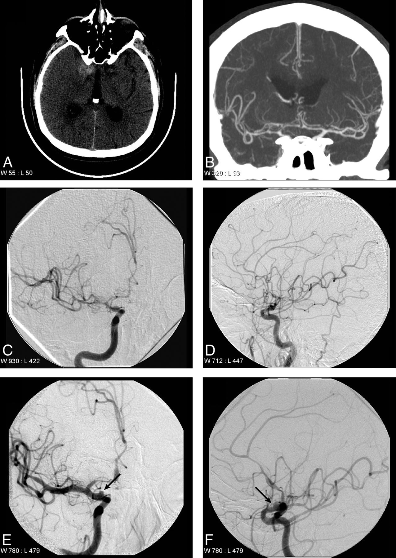 Imaging Evaluation of SAH and Aneurysm