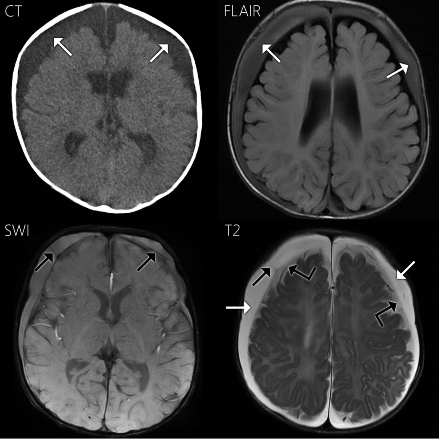 After brain. Epidura subdur. MRI chronic subdural Hemorrhage.