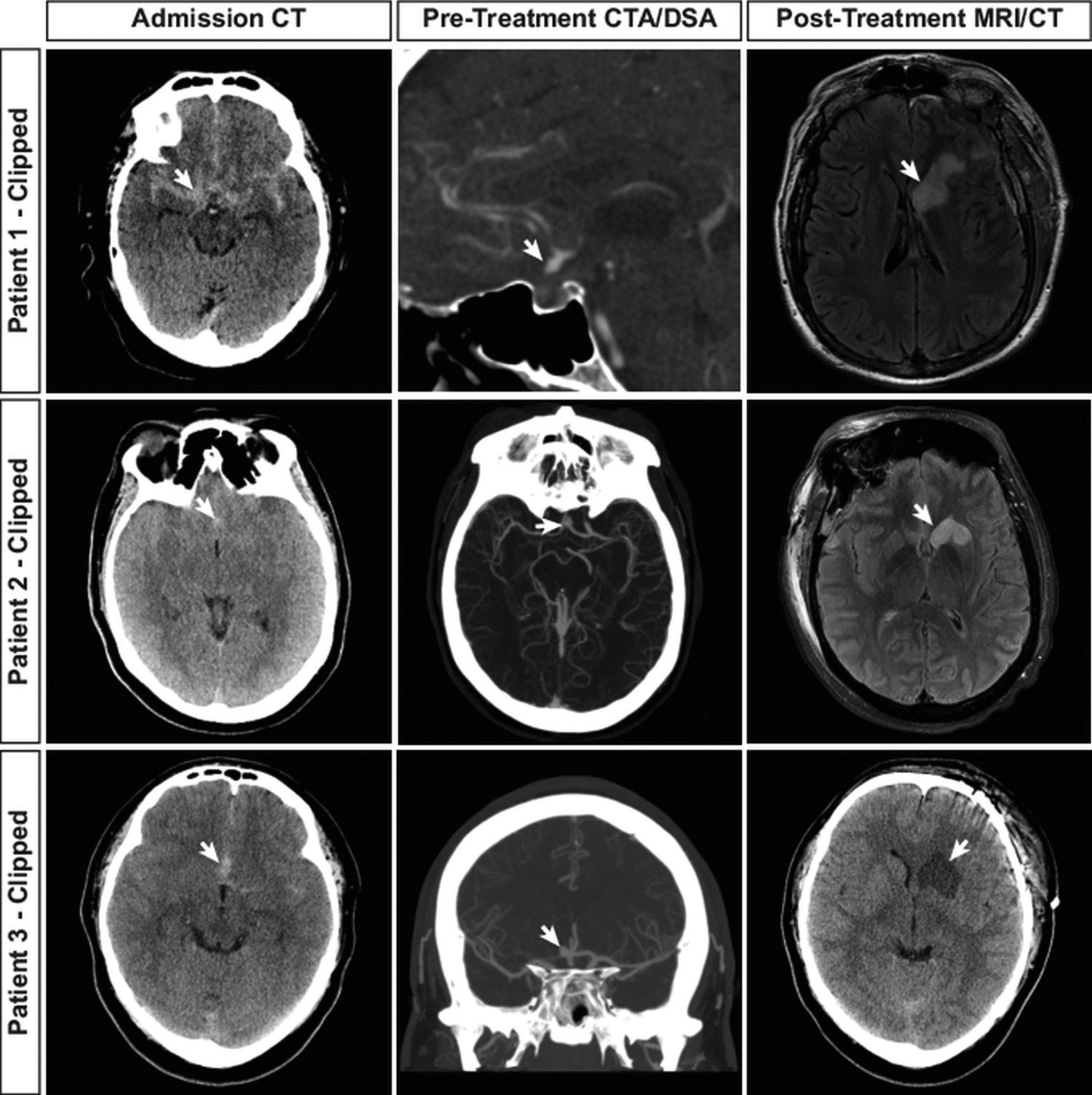 Patient Outcomes and Cerebral Infarction after Ruptured Anterior ...