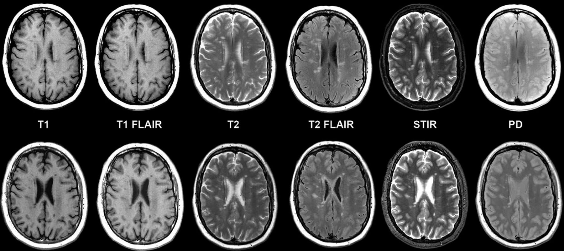 Микроангиопатия головного мозга fazekas. Multiple Sclerosis MRI. Лейкоареоз Fazekas 1. Фазекас мрт. Мрт головного мозга Flair.