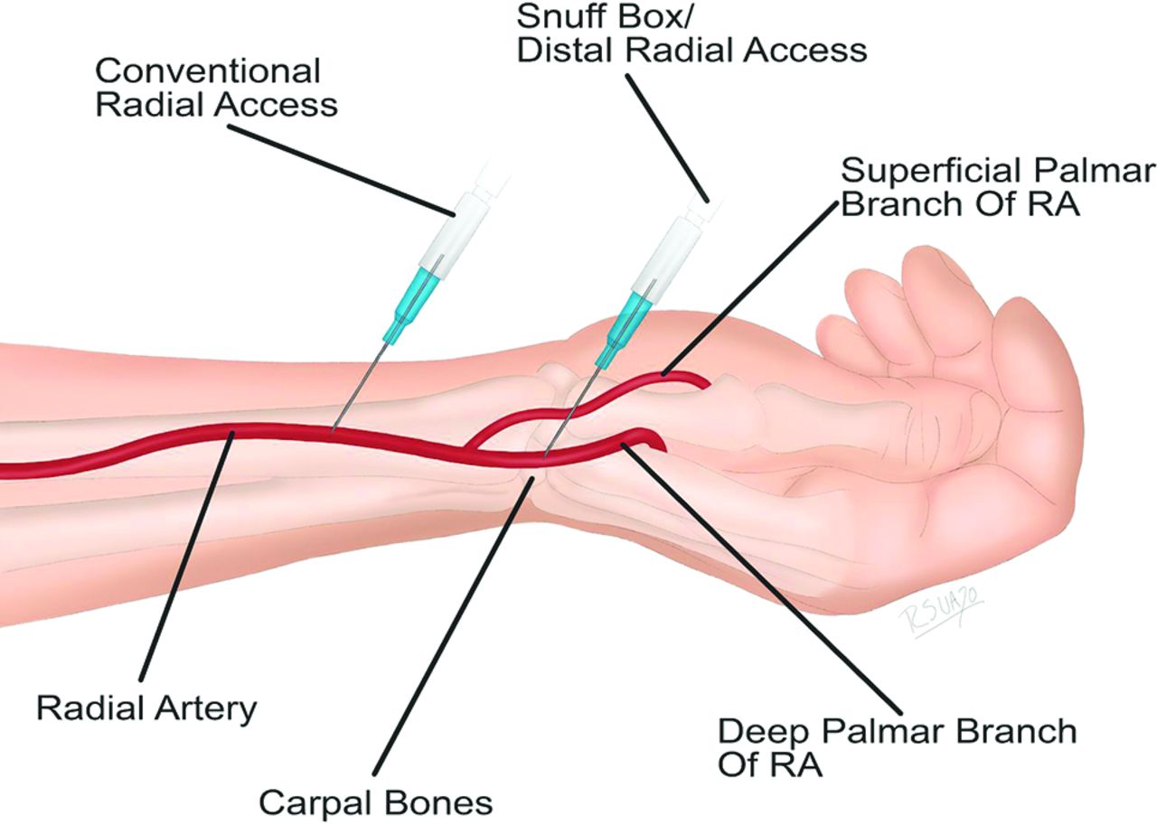 Physio City - 📌ANATOMICAL SNUFF BOX📌 ⠀ THE ANATOMICAL SNUFFBOX [also  known as the radial fossa or tabatière anatomique], is a triangular  depression found on the radial side of the wrist (lateral