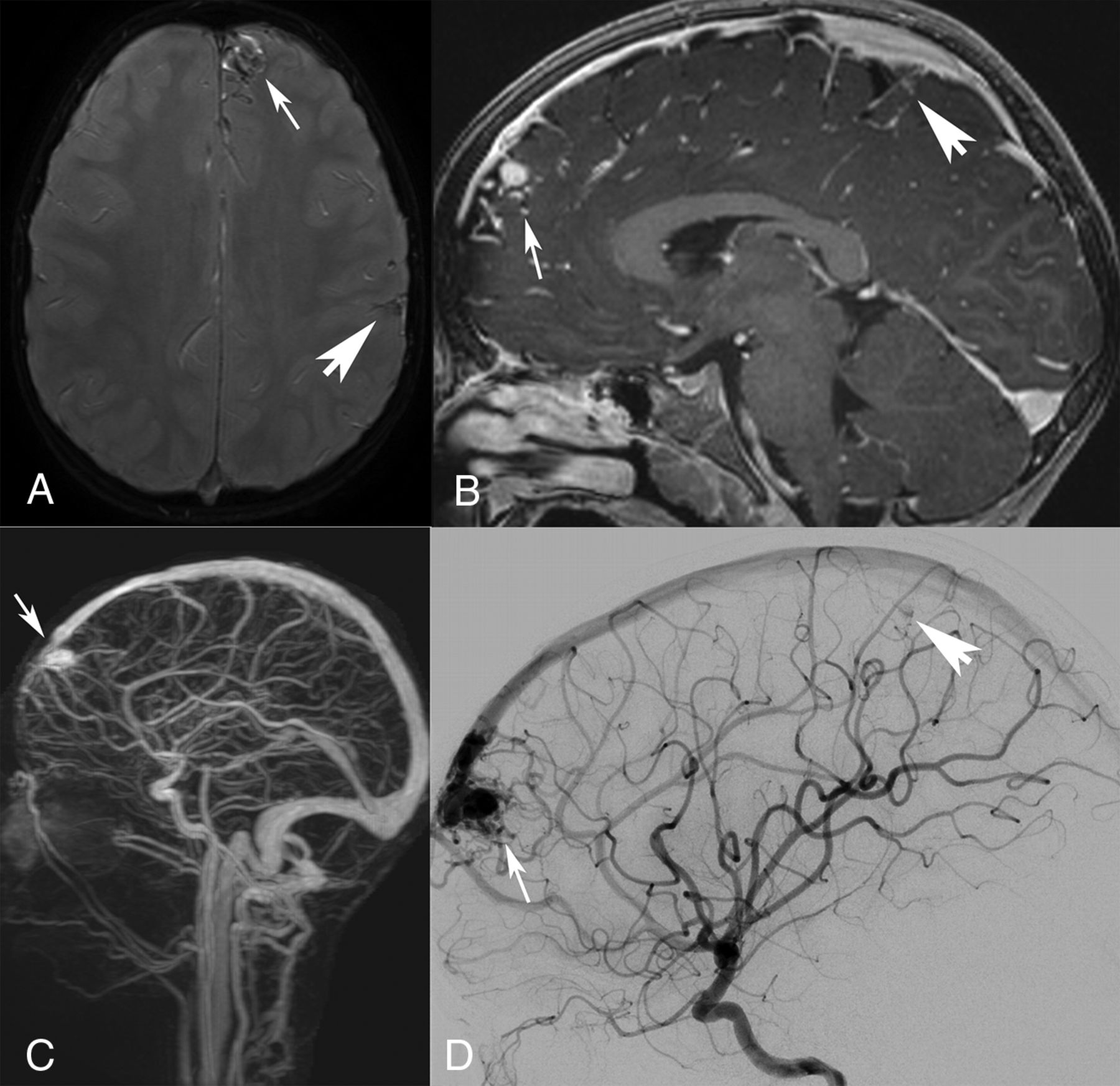 Comparison of MRI, and DSA for Detection of Cerebral Arteriovenous Malformations in Hereditary Hemorrhagic Telangiectasia | Journal of Neuroradiology