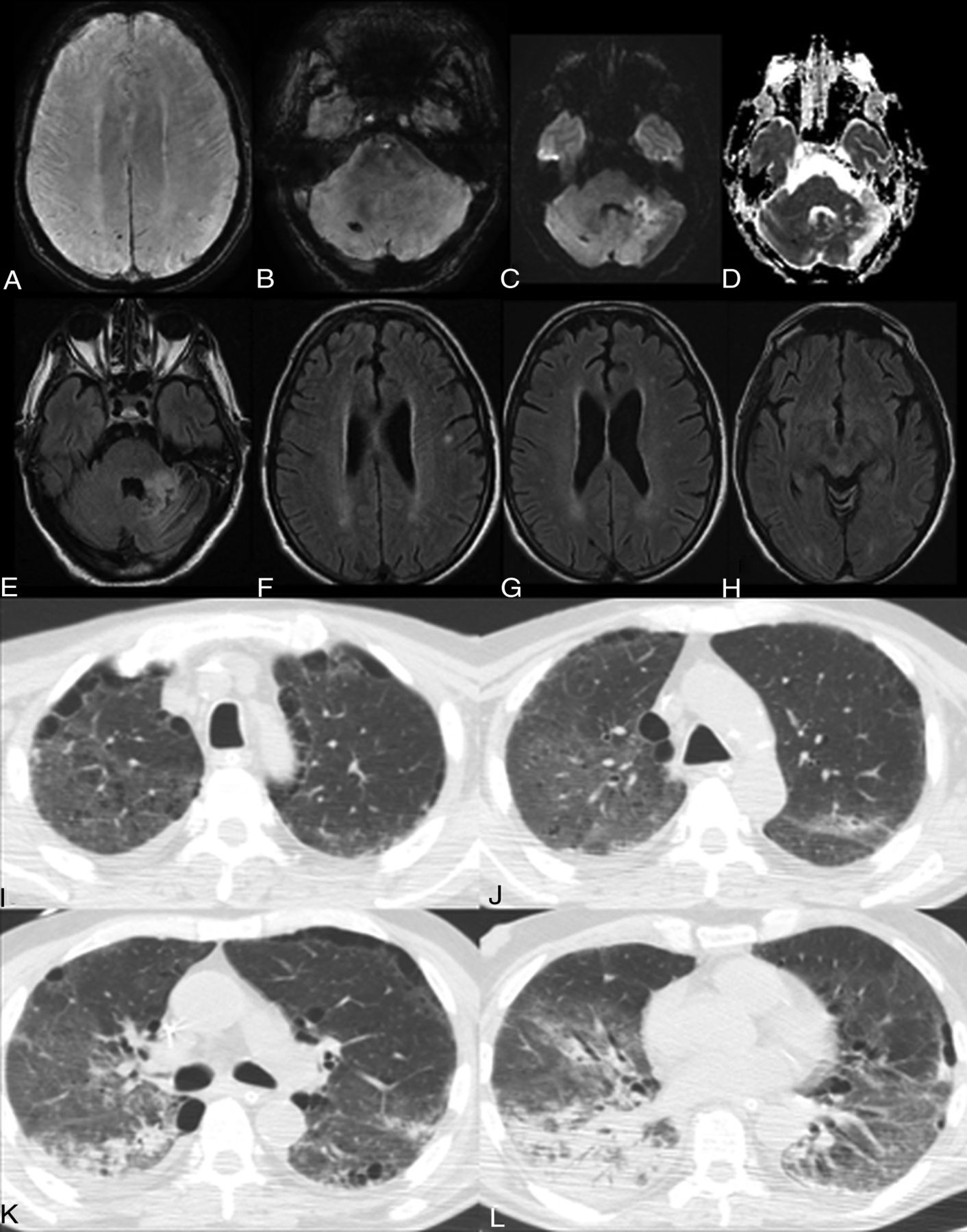 Brain and Lung Imaging Correlation in with COVID-19: Could the Lung Disease Reflect the Prevalence of Acute Abnormalities Neuroimaging? A Global Multicenter Observational Study | American Journal of