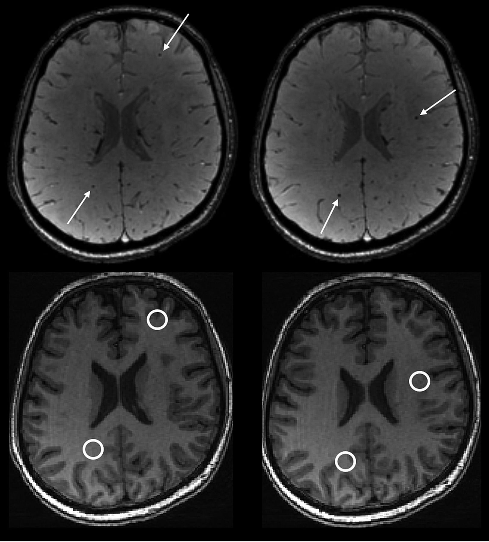 Accumulation of Brain Hypointense Foci on Susceptibility