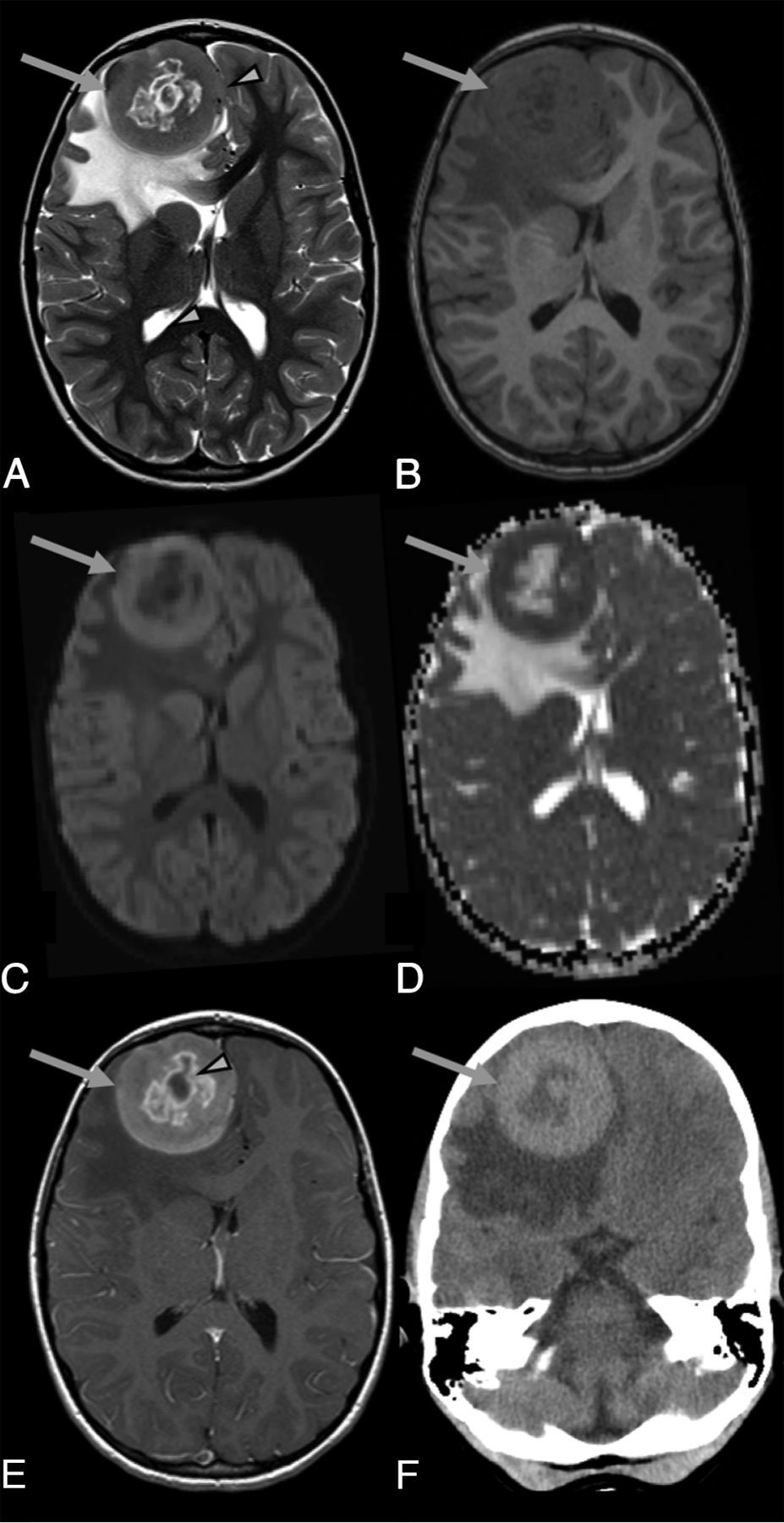 Neuroimaging in Pediatric Patients with Juvenile