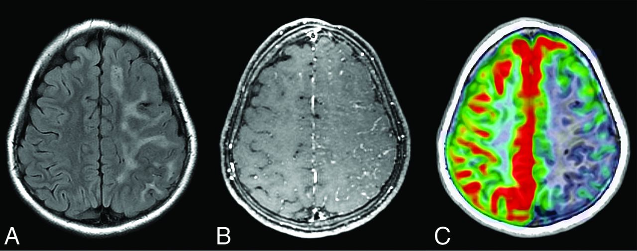 Brain Abnormalities and Epilepsy in Patients with Parry-Romberg Syndrome |  American Journal of Neuroradiology